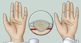 Primjena tlačnog zavoja