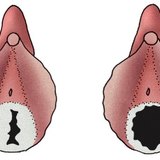Himen mlade djevojke (lijevo) i žene koja živi aktivni seksualni život (desno)