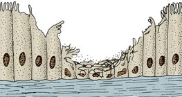 Epitel prekriven cilijama u respiratornom traktu pušača